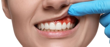 Gum and oral health assessment before dental implants